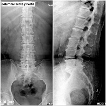 Radiografía digital de columna, frente y perfil