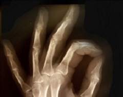 Detalle de imagen radiológica de mano y muñeca