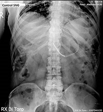 Radiografía de abdomen con control de sonda nasogástrica