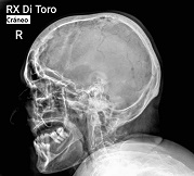 Radiografía digital de cráneo perfil