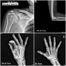 Radiografías de miembro superior: hombro, codo y manos