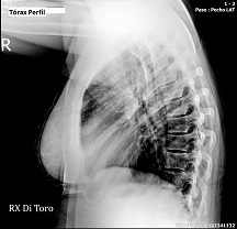 Radiografía de tórax perfil realizada a domicilio